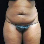 Liposuction Before & After Patient #2208