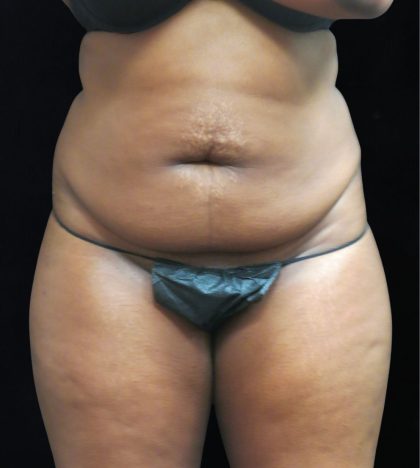 Liposuction Before & After Patient #2208