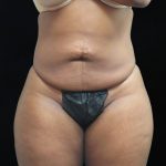 Liposuction Before & After Patient #2208