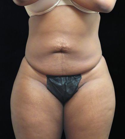 Liposuction Before & After Patient #2208