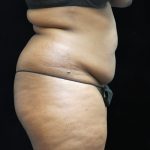 Liposuction Before & After Patient #2208