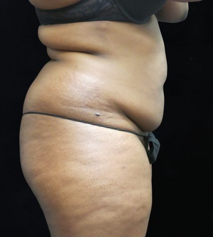 Liposuction Before & After Patient #2208
