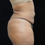 Liposuction Before & After Patient #2208