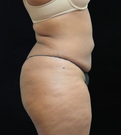 Liposuction Before & After Patient #2208