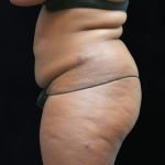 Liposuction Before & After Patient #2208