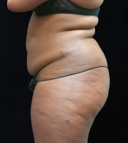 Liposuction Before & After Patient #2208