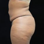 Liposuction Before & After Patient #2208