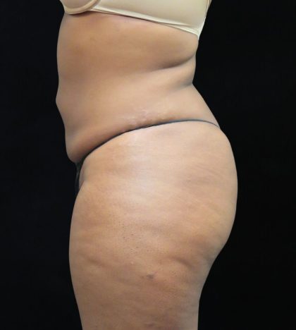 Liposuction Before & After Patient #2208