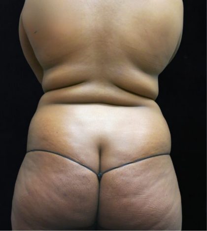 Liposuction Before & After Patient #2208