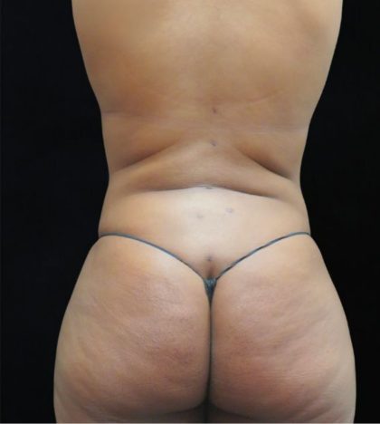 Liposuction Before & After Patient #2208