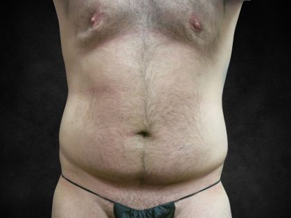 Liposuction Before & After Patient #2217