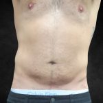 Liposuction Before & After Patient #2217