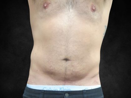 Liposuction Before & After Patient #2217