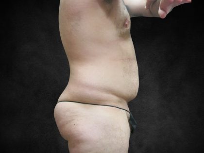 Liposuction Before & After Patient #2217