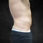 Liposuction Before & After Patient #2217