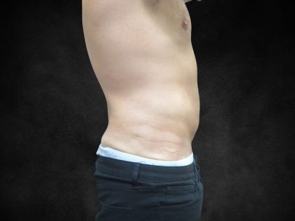 Liposuction Before & After Patient #2217
