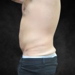 Liposuction Before & After Patient #2217