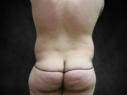 Liposuction Before & After Patient #2217