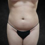 Liposuction Before & After Patient #2236
