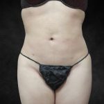 Liposuction Before & After Patient #2236