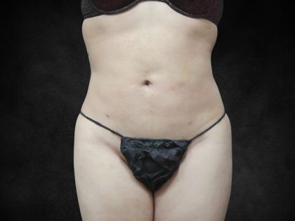 Liposuction Before & After Patient #2236