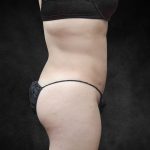 Liposuction Before & After Patient #2236