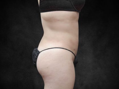 Liposuction Before & After Patient #2236