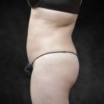 Liposuction Before & After Patient #2236