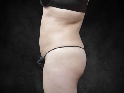 Liposuction Before & After Patient #2236
