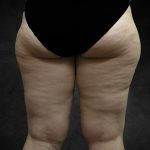 Liposuction Before & After Patient #2241