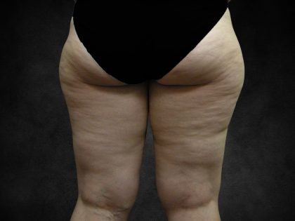 Liposuction Before & After Patient #2241