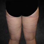 Liposuction Before & After Patient #2241
