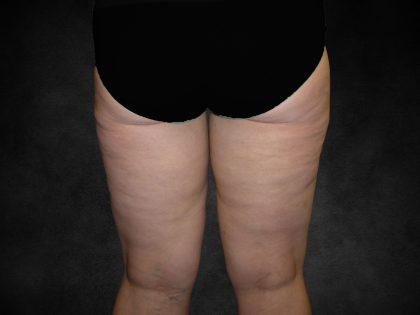 Liposuction Before & After Patient #2241