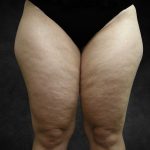 Liposuction Before & After Patient #2241