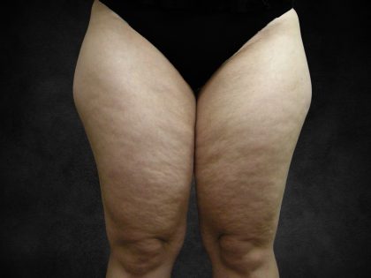 Liposuction Before & After Patient #2241