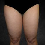 Liposuction Before & After Patient #2241