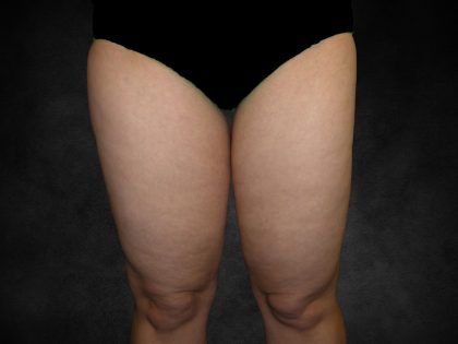 Liposuction Before & After Patient #2241