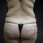 Liposuction Before & After Patient #2244