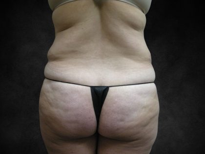 Liposuction Before & After Patient #2244