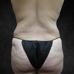 Liposuction Before & After Patient #2244