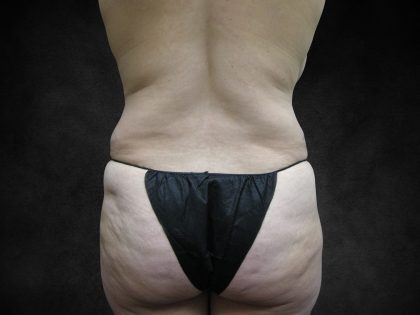 Liposuction Before & After Patient #2244