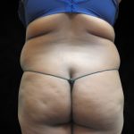 Liposuction Before & After Patient #2247