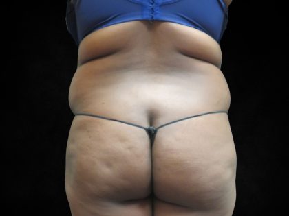 Liposuction Before & After Patient #2247