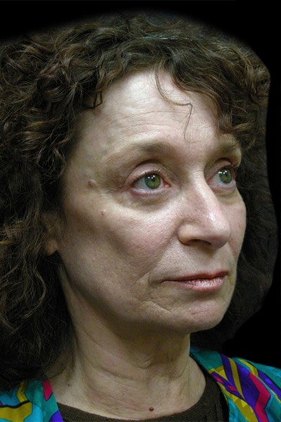 Neck Lift Before & After Patient #2664