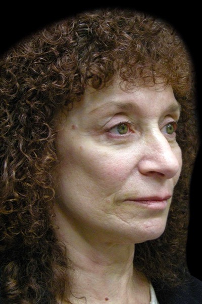 Neck Lift Before & After Patient #2664