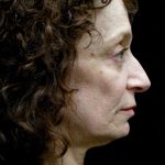 Neck Lift Before & After Patient #2664