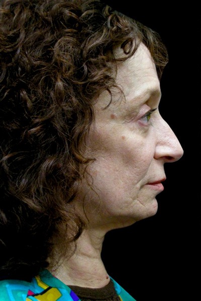 Neck Lift Before & After Patient #2664