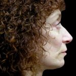 Neck Lift Before & After Patient #2664