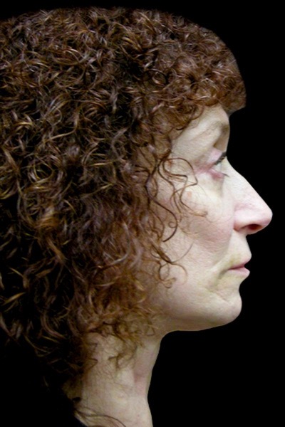 Neck Lift Before & After Patient #2664