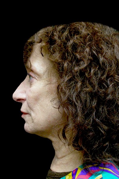 Neck Lift Before & After Patient #2664